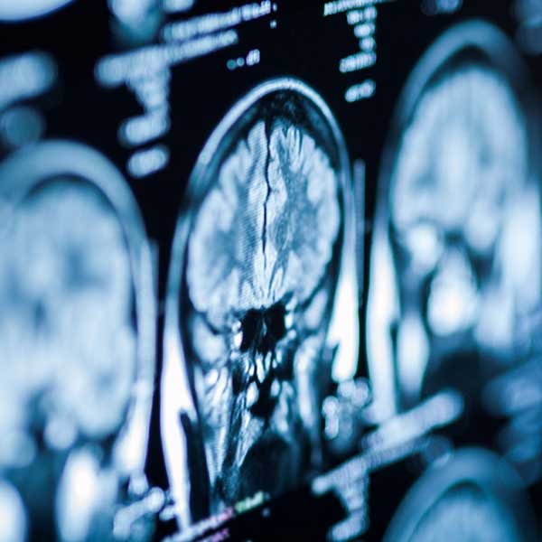 Head and brain injury from accident